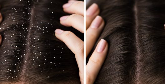 6 Effective Hair Masks to cure Dandruff!